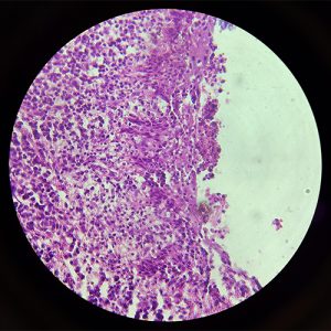 ضایعات دهانی در زیر میکروسکوپ